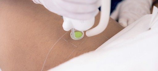 Intimbereich lasern Erlangen