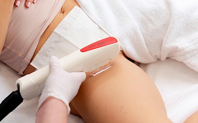 Intimbereich lasern in Erlangen