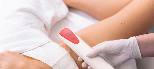 Lasern der Intimzone