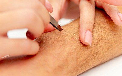 Ablauf Dauerhafte Haarentfernung Gesicht Erlangen