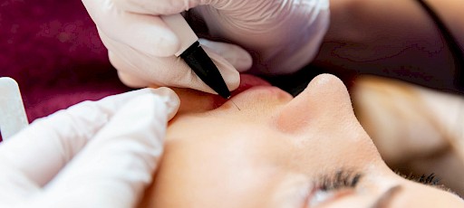 Nadelepilation Gesicht Erlangen