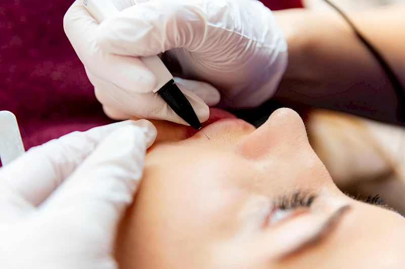 Nadelepilation Gesicht Erlangen