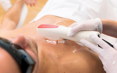 Brusthaare entfernen in Erlangen