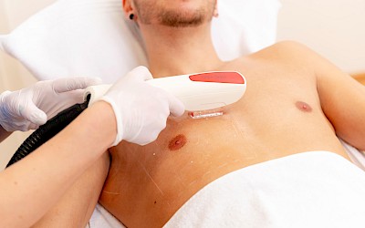 Nachsorge nach der Brusthaarentfernung in Erlangen