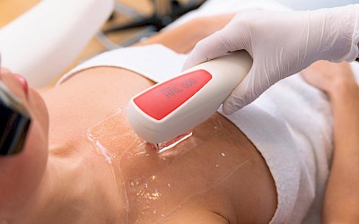 Brusthaare lasern für Frauen in Erlangen