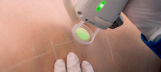 Bauchhaare entfernen Erlangen