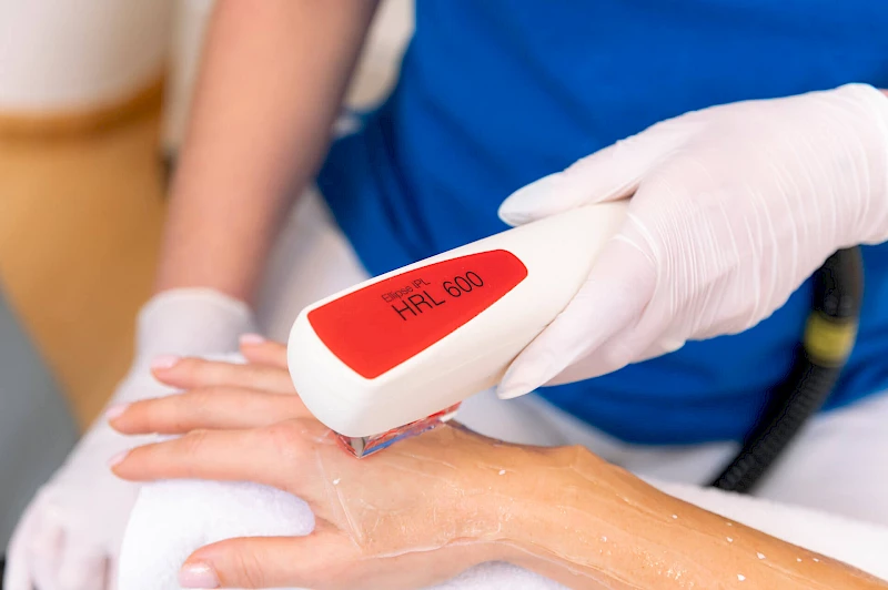 Lasern der Hände in Erlangen