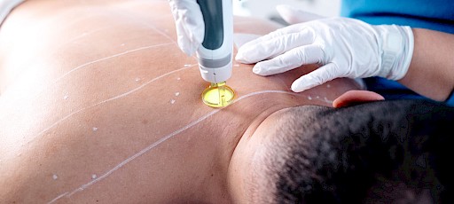 Dauerhafte Haarentfernung Rücken Erlangen