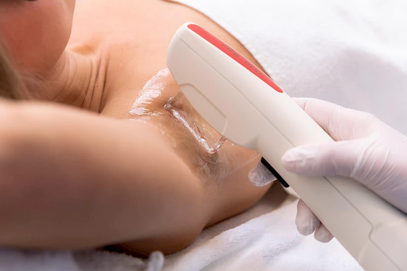 Haarentfernung der Achseln in Erlangen