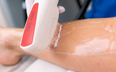 Beine lasern in Erlangen