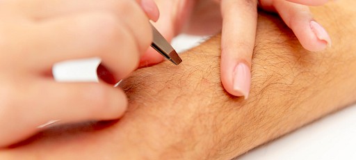 Haaranalyse Dauerhafte Haarentfernung Erlangen