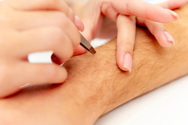 Haaranalyse Dauerhafte Haarentfernung Erlangen