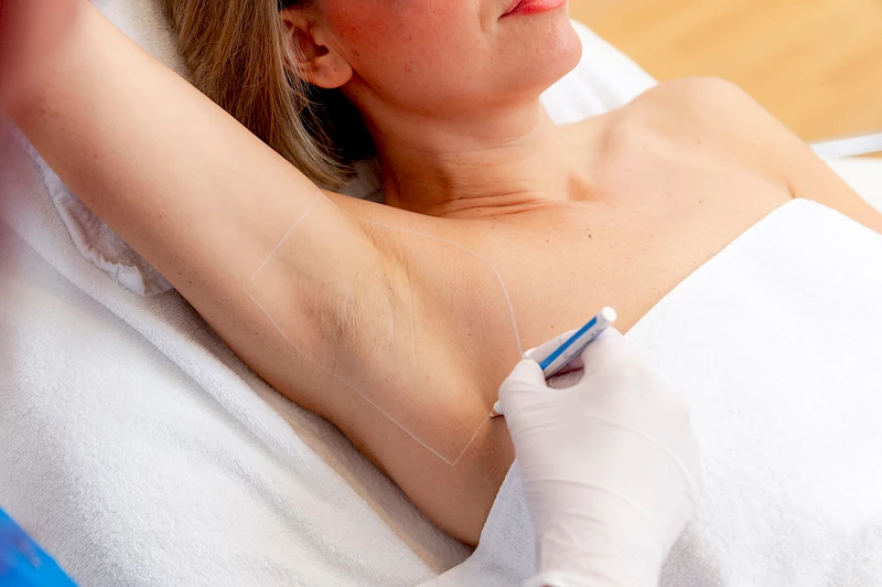 Laser Haarentfernung Erlangen