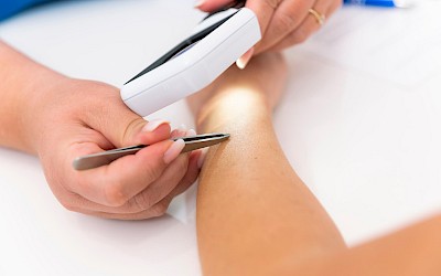 Behandlungsablauf der dauerhaften Haarentfernung in Erlangen