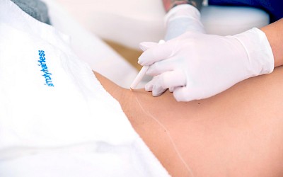 Vorteile der Laserbehandlung im Intimbereich Frankfurt am Main