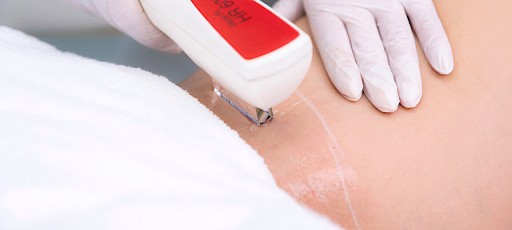 SWT-Behandlung des Intimbereichs