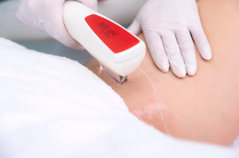 SWT-Behandlung des Intimbereichs