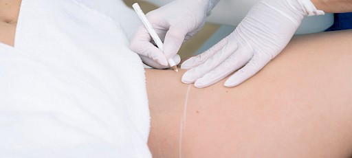 Vorbereitung zu dauerhaften Haarentfernung Frankfurt am Main