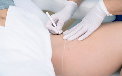 Intimbereich vs. Bikinizone lasern Frankfurt