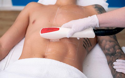 Bauchhaare entfernen in Frankfurt