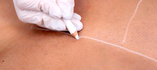 Vorbereitung zum Bauchhaare entfernen Frankfurt am Main