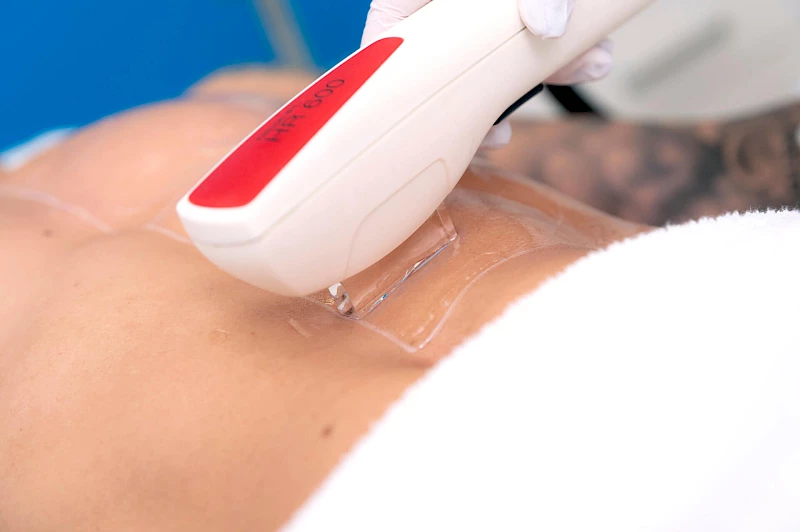 Bauchhaare entfernen Mann: Behandlung