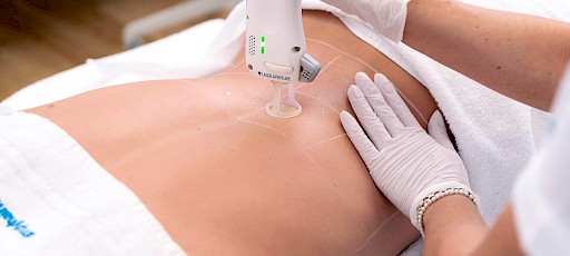 Dauerhafte Haarentfernung Rücken Frankfurt am Main