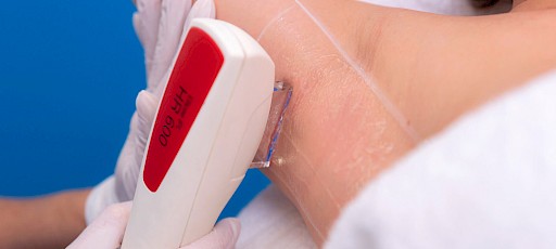 Achseln lasern Frankfurt