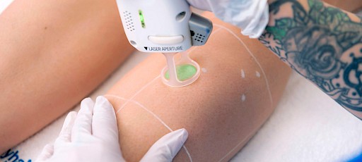 Beine lasern Frankfurt