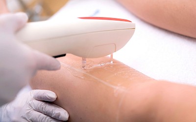 Beine lasern in Frankfurt am Main