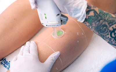 Behandlungsablauf für das Beine lasern in Frankfurt am Main