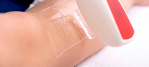 Dauerhafte Haarentfernung an den Beinen in Frankfurt am Main