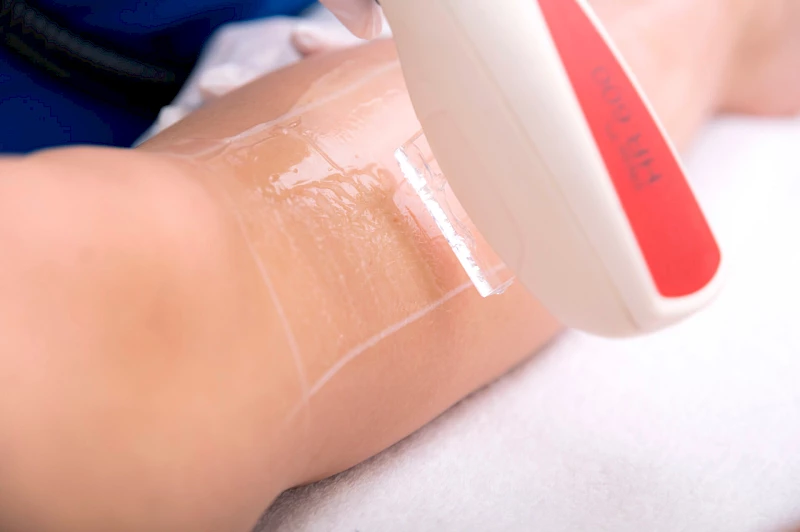 Dauerhafte Haarentfernung an den Beinen in Frankfurt am Main