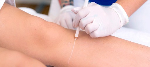 Füße lasern Frankfurt am Main