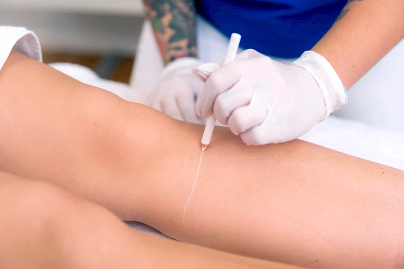 Füße lasern Frankfurt am Main