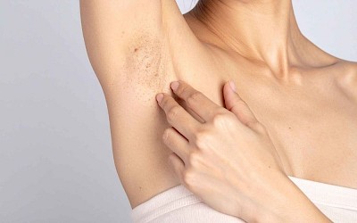 Eine Frau hat Probleme mit eingewachsenen Haaren und zeigt auf ihre Achseln