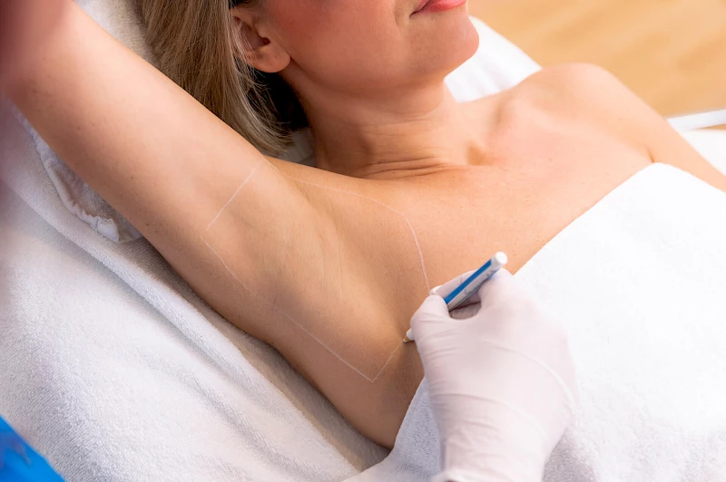 Underarm lasering in Mannheim